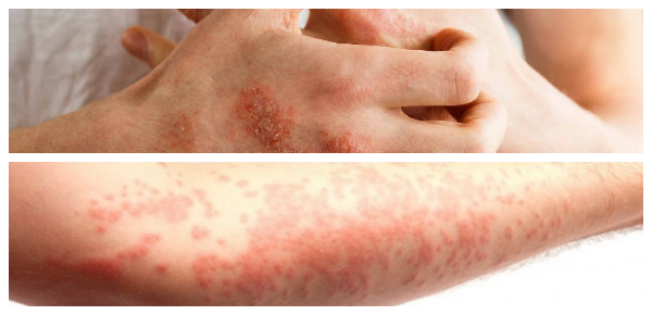 late onset of eczema