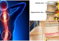 degenerative disc disease back pain