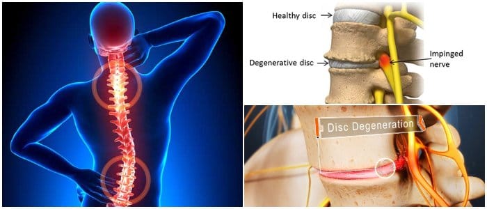 degenerative disc disease back pain