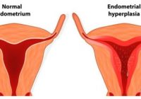 endometrial hyperplasia symptoms