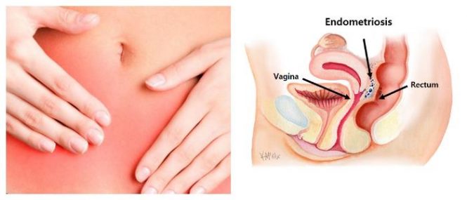 endometriosis pain