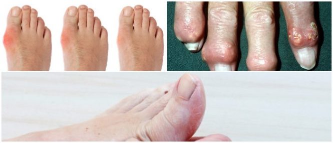 gout symptoms and causes