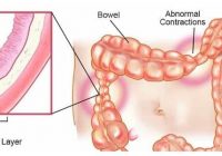 irritable bowel syndrome symptoms