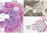 pathophysiology of asthma attack