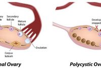 polycystic ovary syndrome (pcos)
