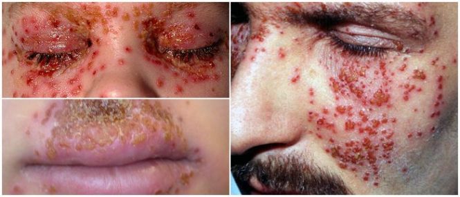 eczema herpeticum blisters