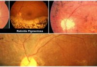 retinitis pigmentosa causes