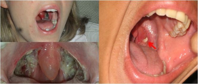 thermal fusion tonsillectomy mouth