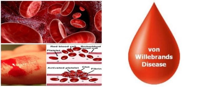 Von Willebrand’s disease: Types, Causes, Symptoms, Diagnosis, Treatment