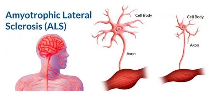 Lou Gehrigs Disease