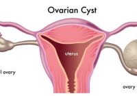 ovarian cyst causes and symptoms