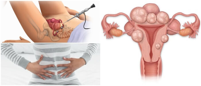 fibroids in uterus