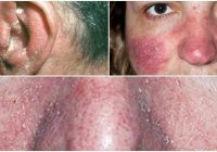 seborrheic dermatitis on face treatment