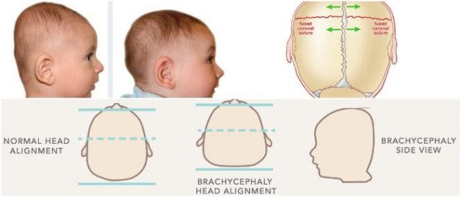 brachycephaly definition