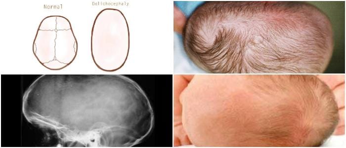 dolichocephaly causes