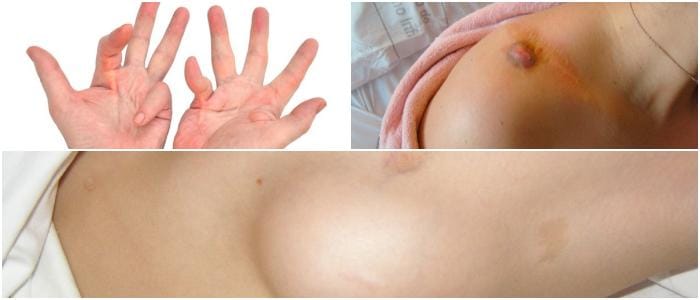 fibromatosis causes and treatment