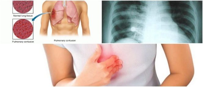 pulmonary contusion icd 10