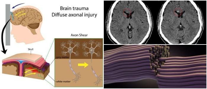 Diffuse Axonal Injury Causes, Symptoms, Diagnosis, and Treatment