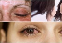 treatment for psoriasis on the eyelid