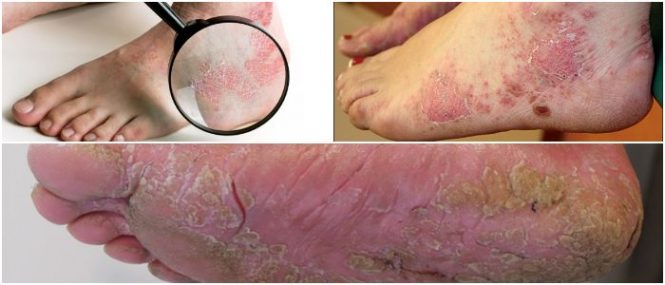 how to treat psoriasis on feet