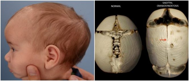 a form of isolated craniosynostosis