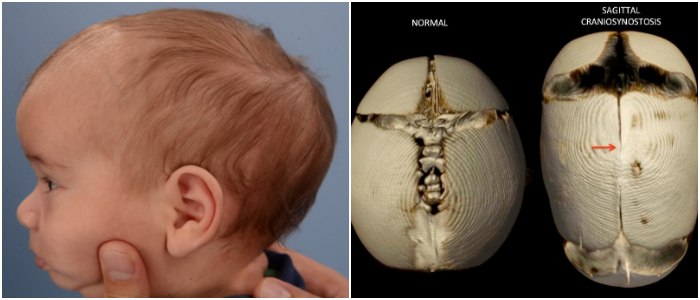 Sagittal Craniosynostosis: Causes, Signs and Symptoms, Diagnosis, and