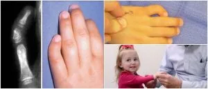 abnormally bent or curved finger