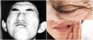 neurological movement disorder